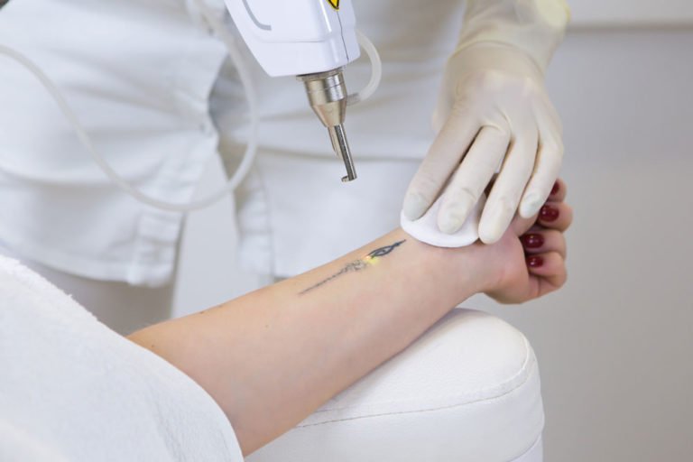 Laser para Remoção de Tatuagem Enlapy Dermatologia estética